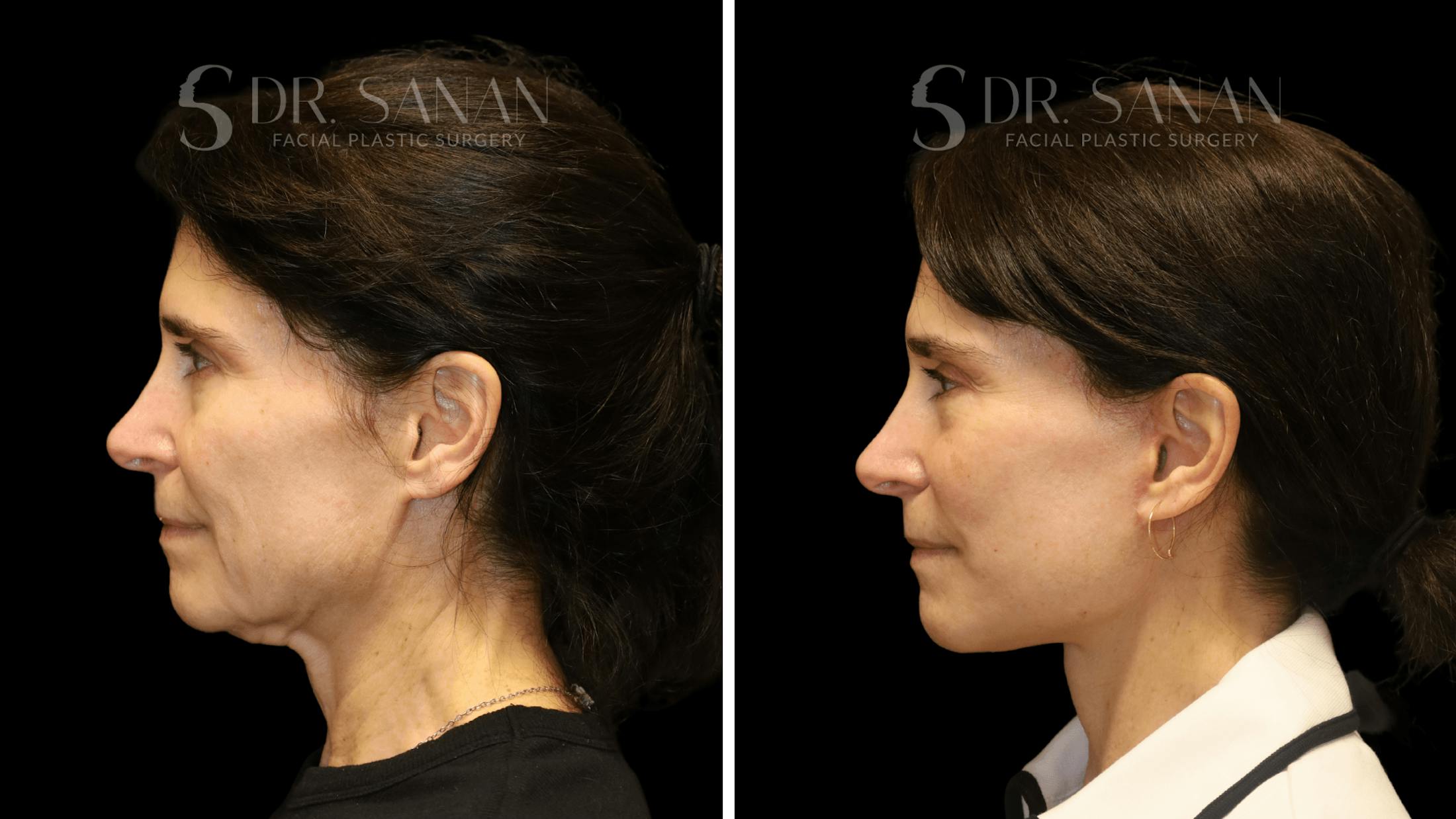 Brow Lift Before & After Gallery - Patient 422921 - Image 5