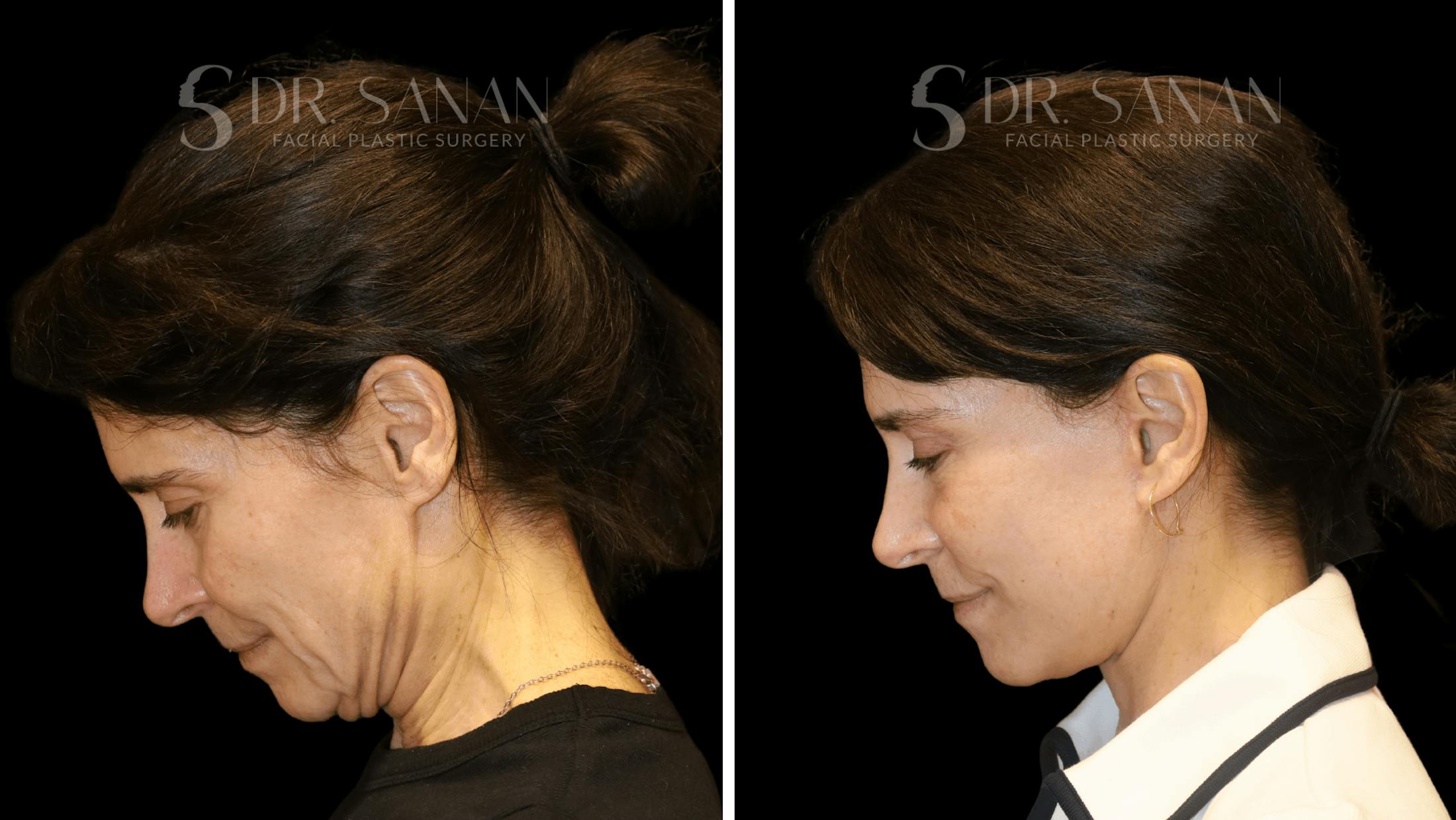 Brow Lift Before & After Gallery - Patient 422921 - Image 8