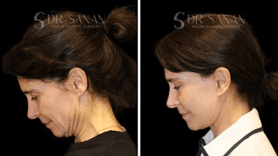 Neck Lift Before & After Gallery - Patient 419411 - Image 1