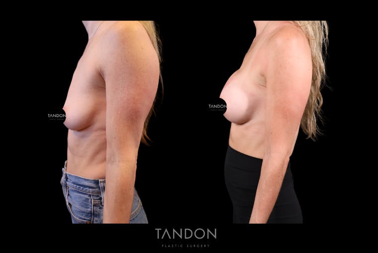 Preservé by Motiva Breast Augmentation Before & After Gallery - Patient 415631 - Image 3