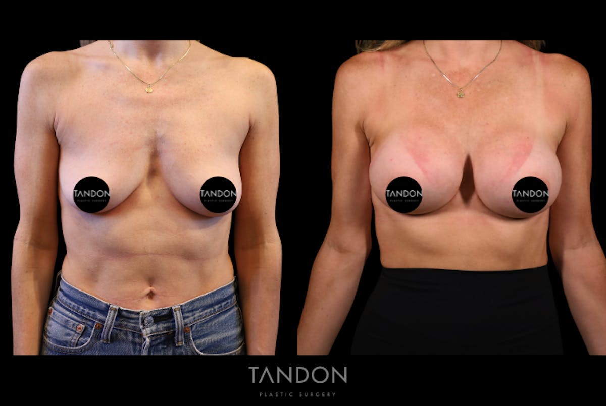 Preservé by Motiva Breast Augmentation Before & After Gallery - Patient 415631 - Image 1