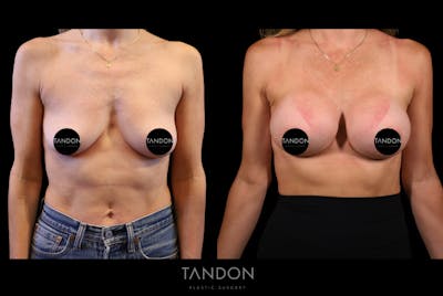 Preservé by Motiva Breast Augmentation Before & After Gallery - Patient 415631 - Image 1