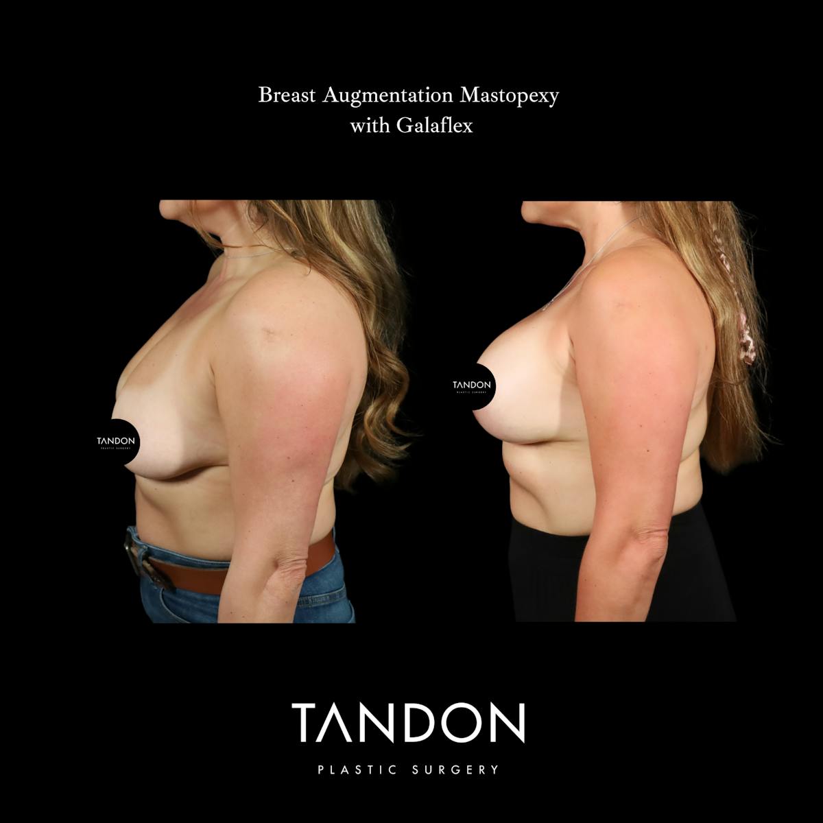Breast Revision Before & After Gallery - Patient 152993 - Image 5