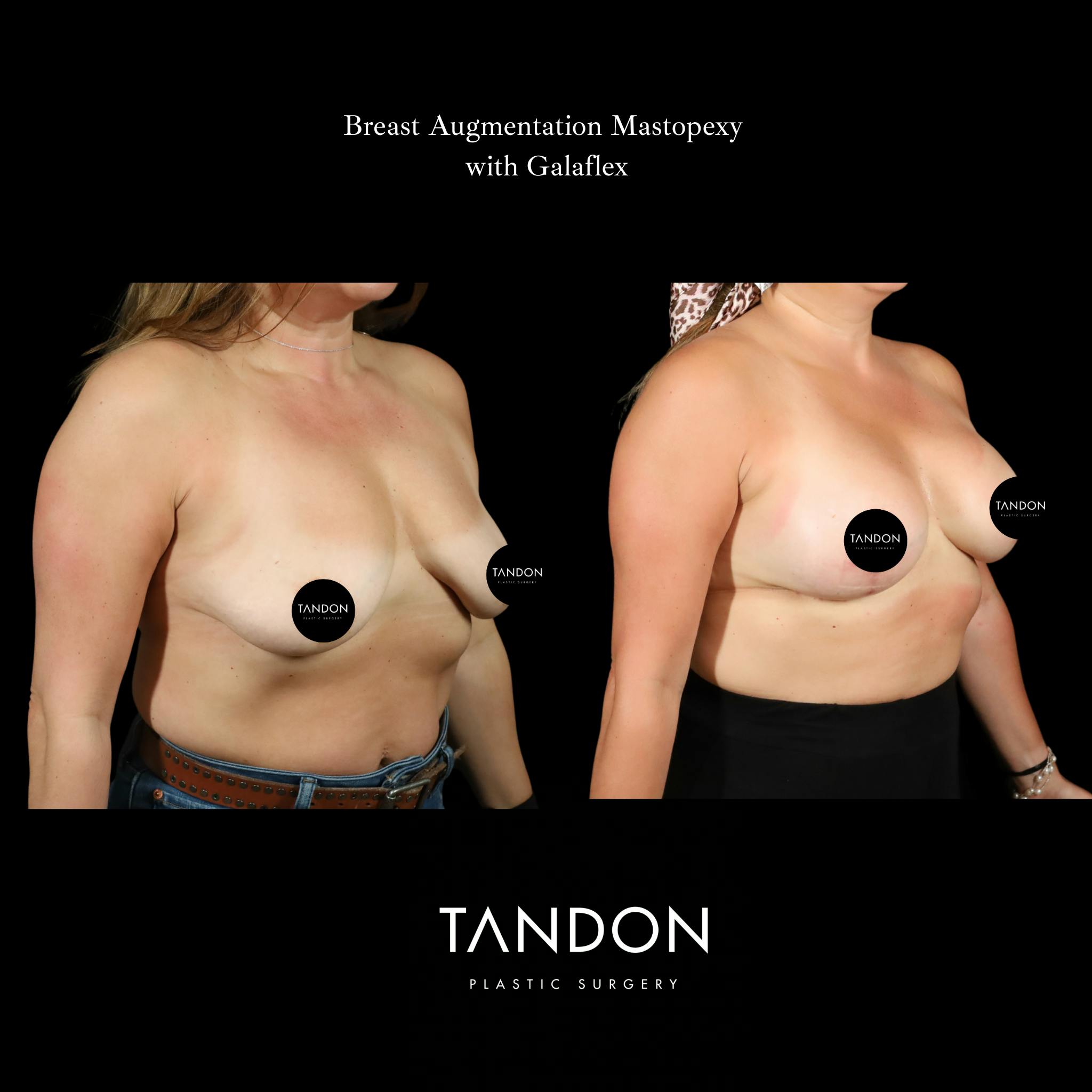 Breast Revision Before & After Gallery - Patient 152993 - Image 2