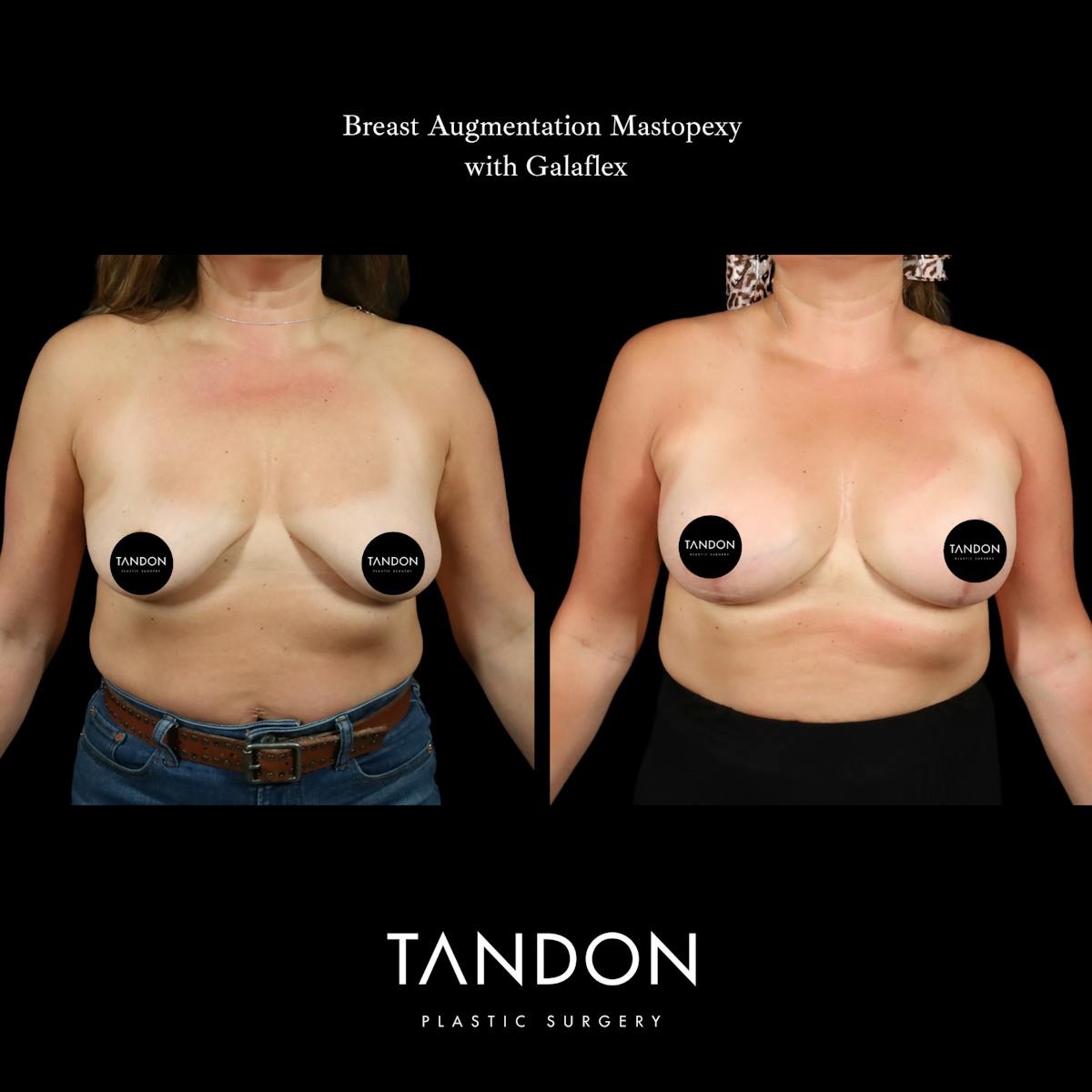 Breast Revision Before & After Gallery - Patient 152993 - Image 1