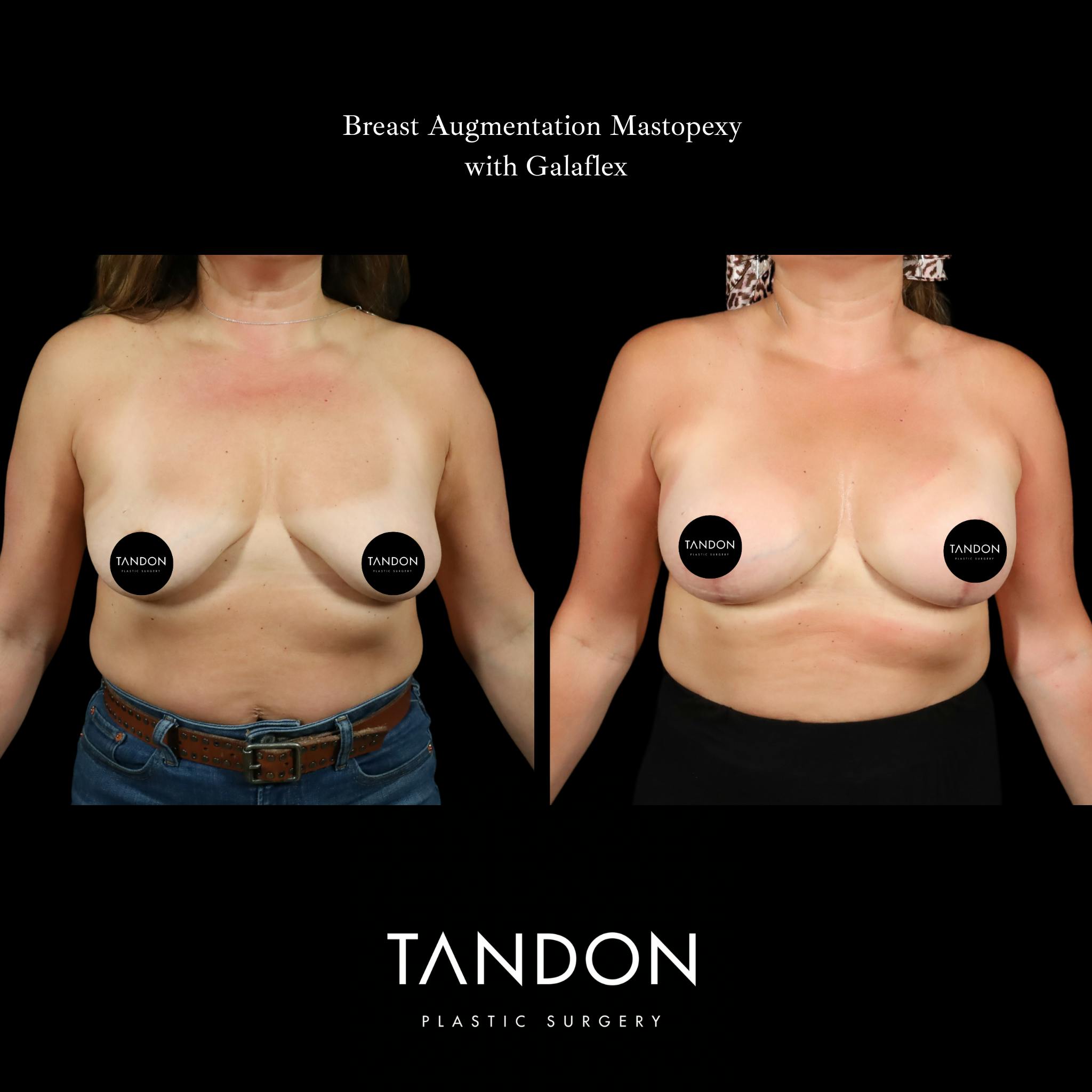 Breast Revision Before & After Gallery - Patient 152993 - Image 1