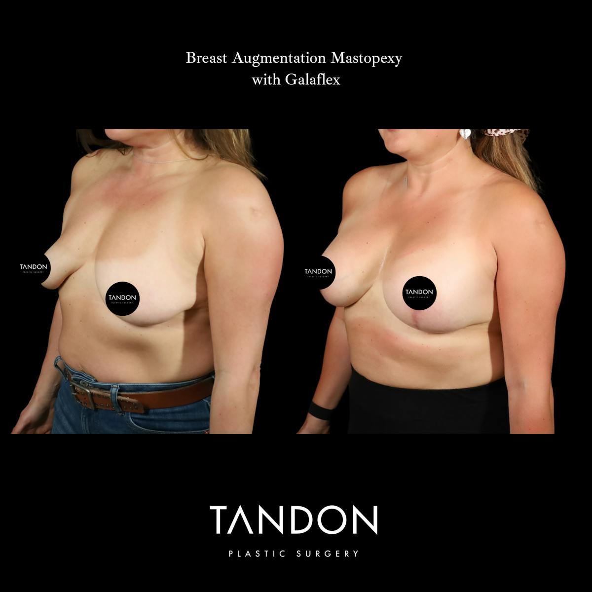 Breast Revision Before & After Gallery - Patient 152993 - Image 4