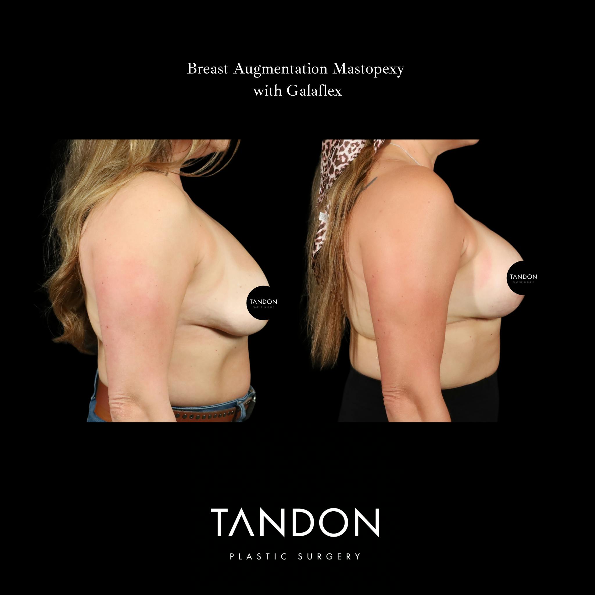 Breast Revision Before & After Gallery - Patient 152993 - Image 3