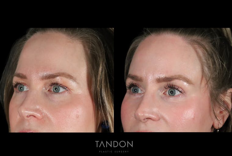 Fat Grafting Before & After Gallery - Patient 337474 - Image 3