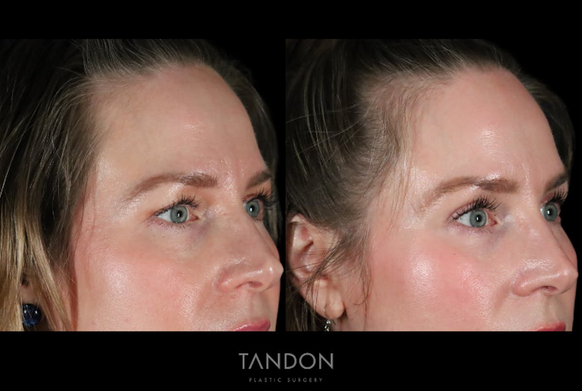 Fat Grafting Before & After Gallery - Patient 337474 - Image 2