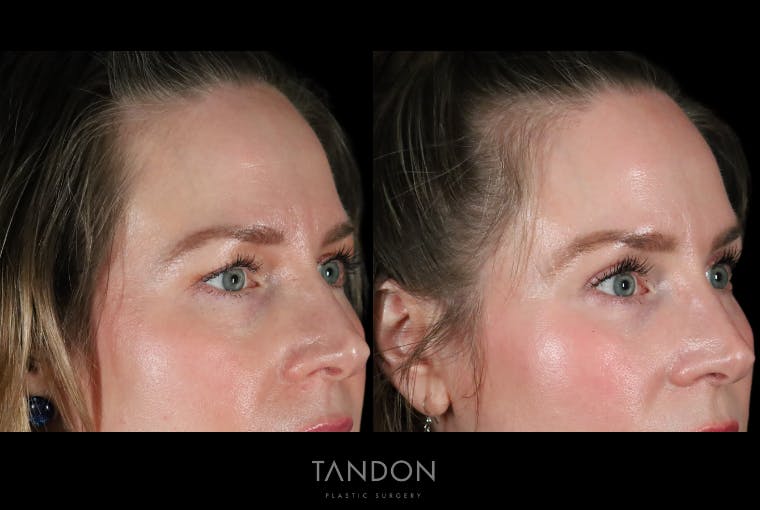 Fat Grafting Before & After Gallery - Patient 337474 - Image 2