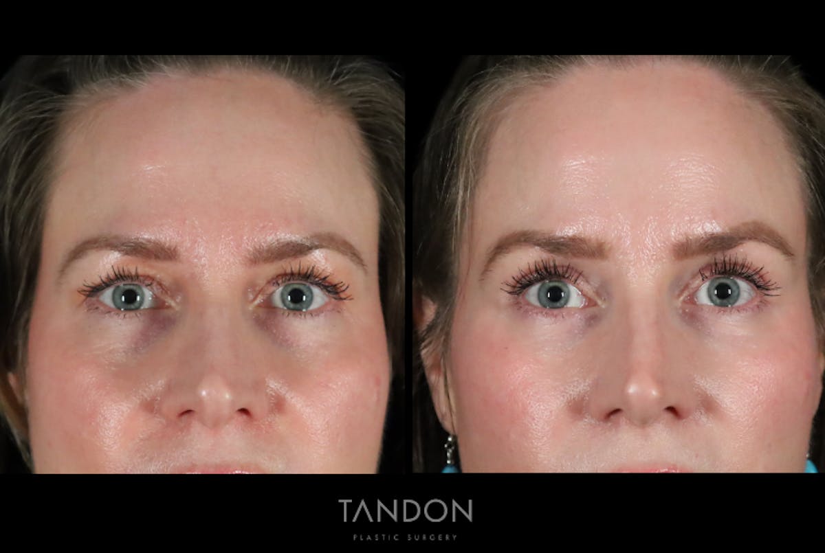 Fat Grafting Before & After Gallery - Patient 337474 - Image 1
