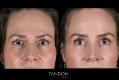 Fat Grafting Before & After Gallery - Patient 337474 - Image 1