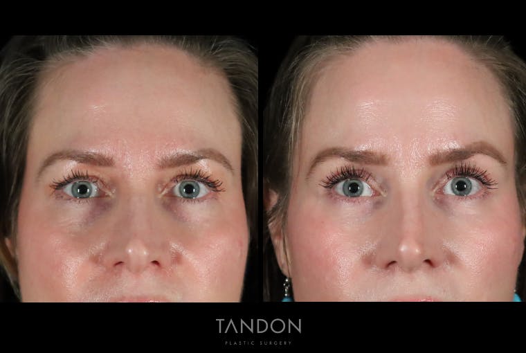 Fat Grafting Before & After Gallery - Patient 337474 - Image 1