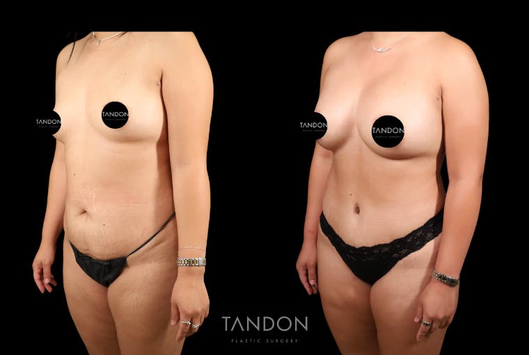 Mommy Makeover Before & After Gallery - Patient 396329 - Image 5