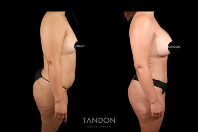 Abdominoplasty (Tummy Tuck) Before & After Gallery - Patient 396506 - Image 2