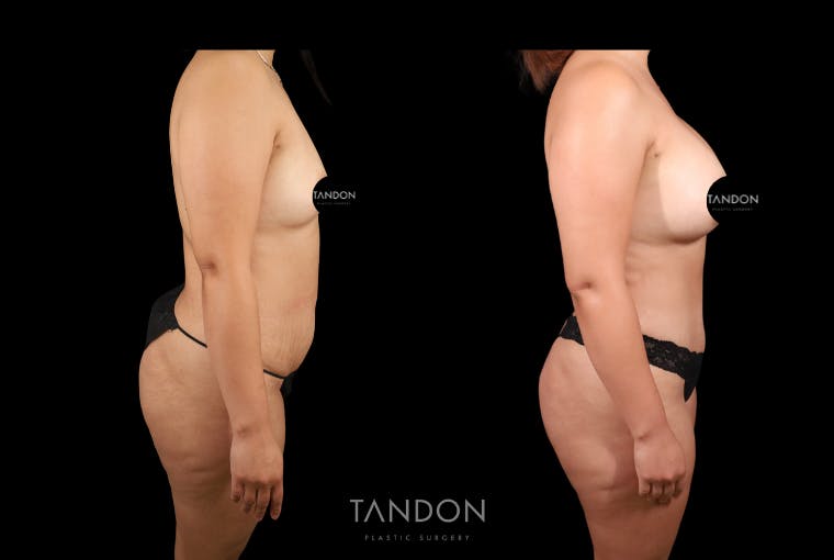 Mommy Makeover Before & After Gallery - Patient 396329 - Image 2
