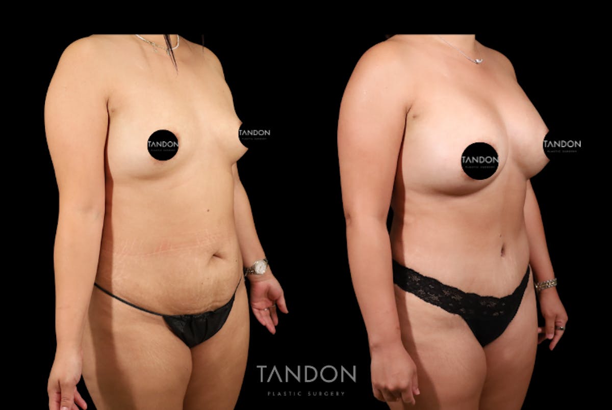 Mommy Makeover Before & After Gallery - Patient 396329 - Image 3