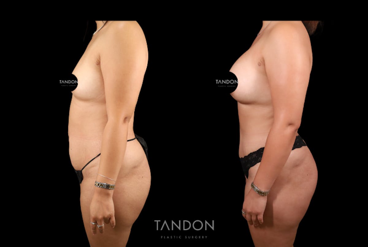 Mommy Makeover Before & After Gallery - Patient 396329 - Image 4