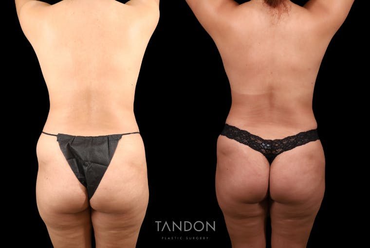 Mommy Makeover Before & After Gallery - Patient 396329 - Image 7