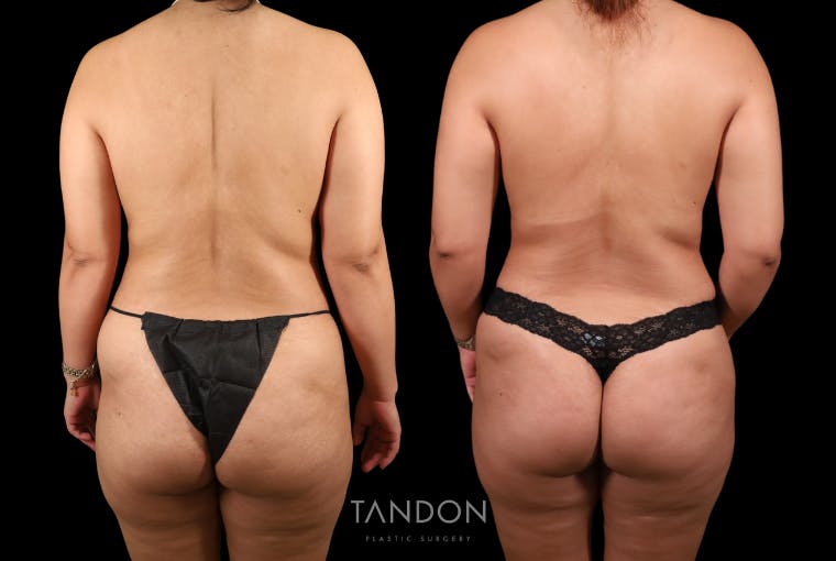 Mommy Makeover Before & After Gallery - Patient 396329 - Image 6