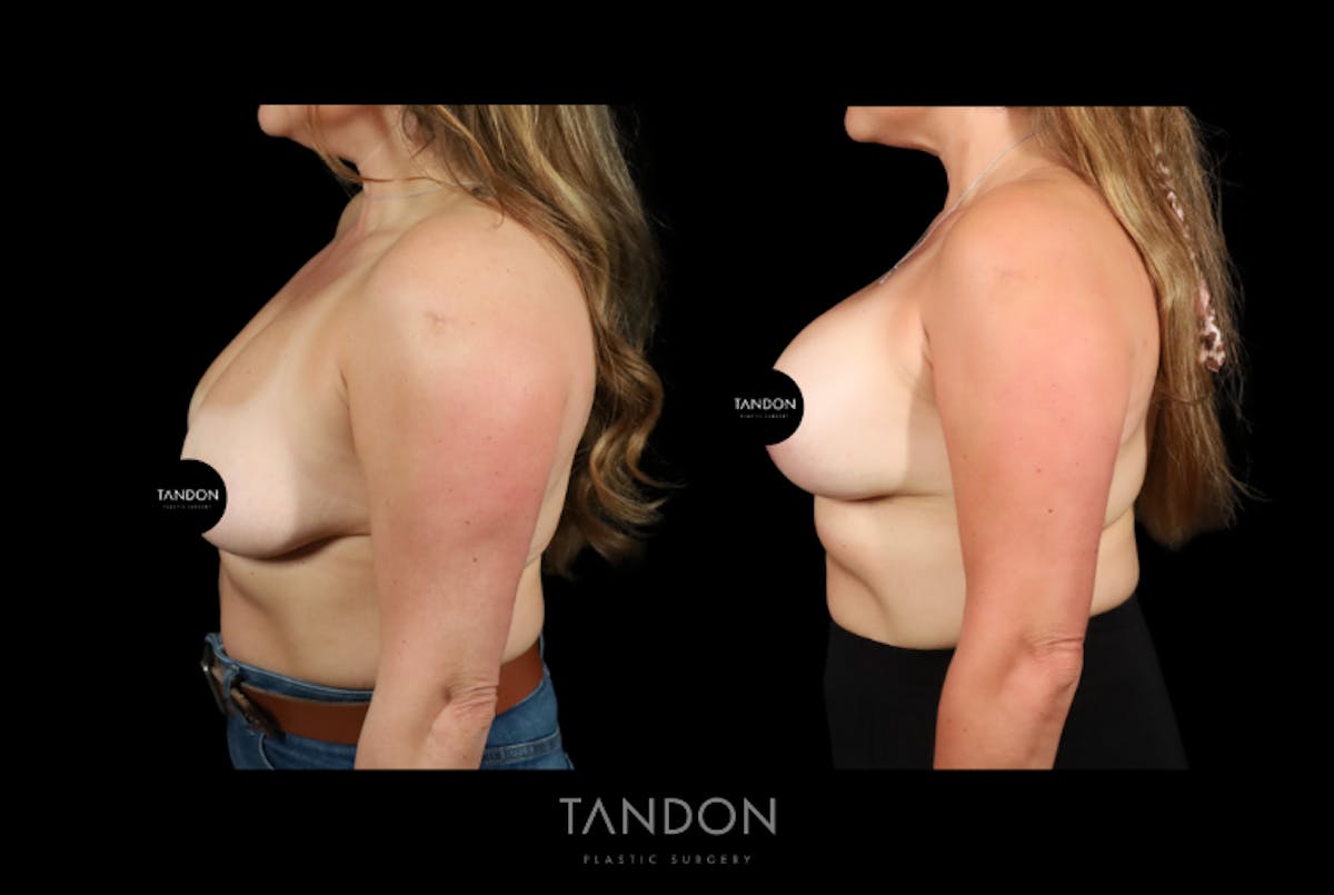 Breast Implant Exchange Before & After Gallery - Patient 305896 - Image 5