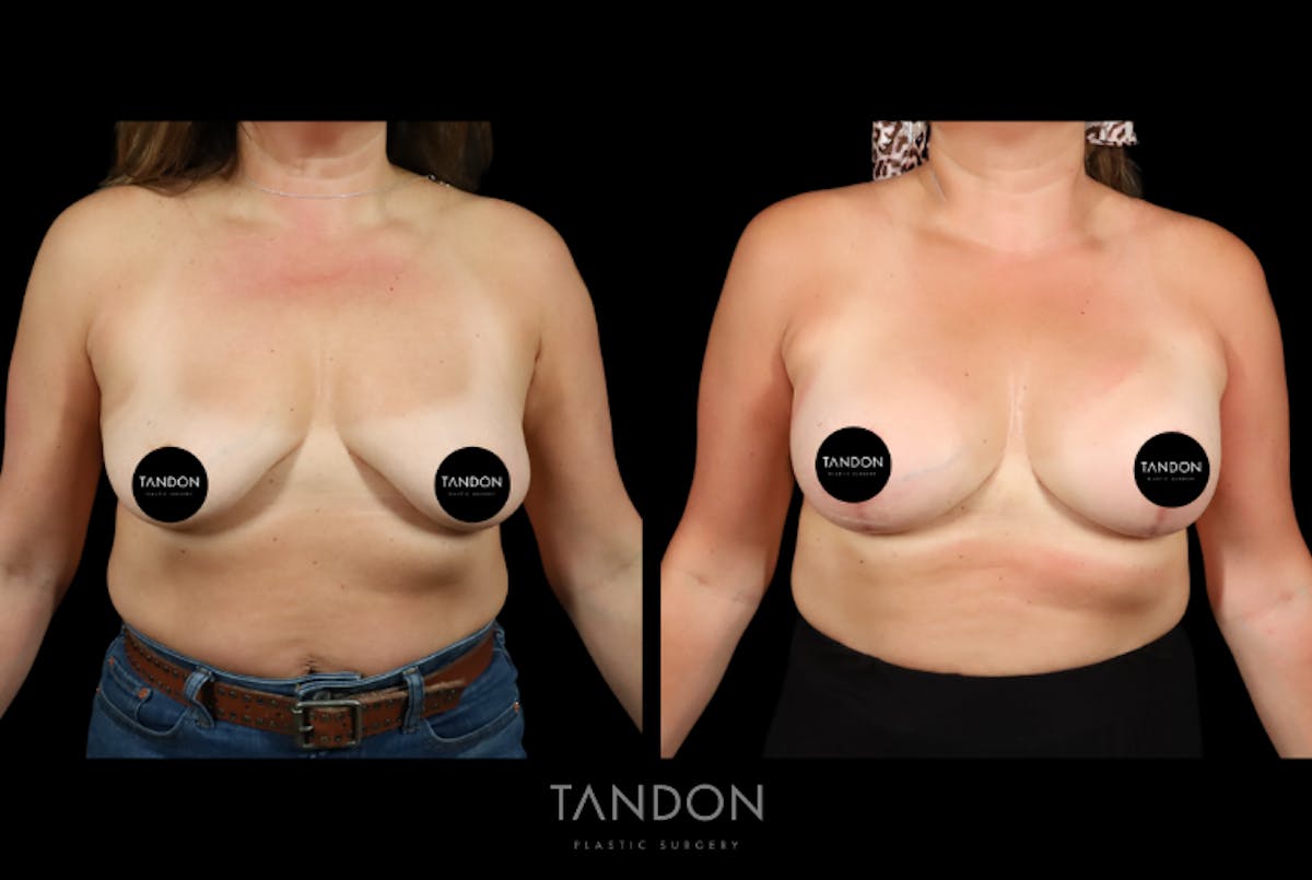 Breast Implant Exchange Before & After Gallery - Patient 305896 - Image 1