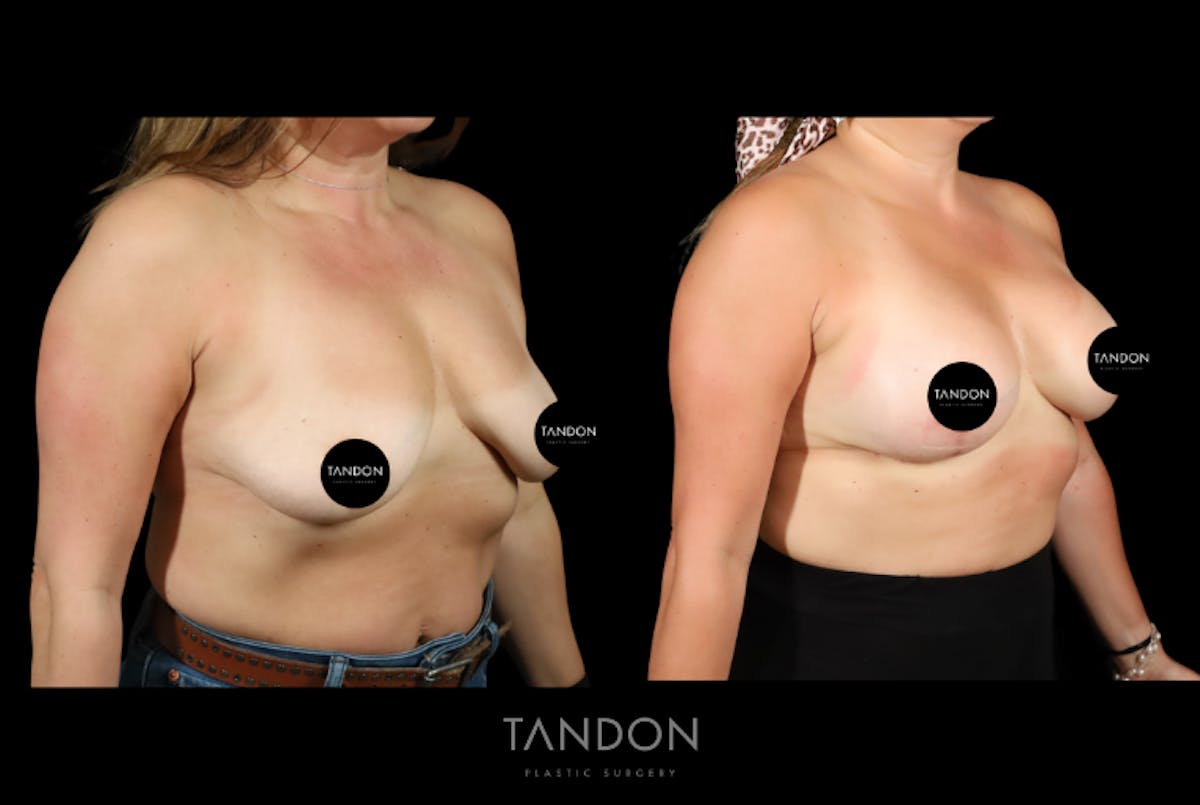 Breast Implant Exchange Before & After Gallery - Patient 305896 - Image 2