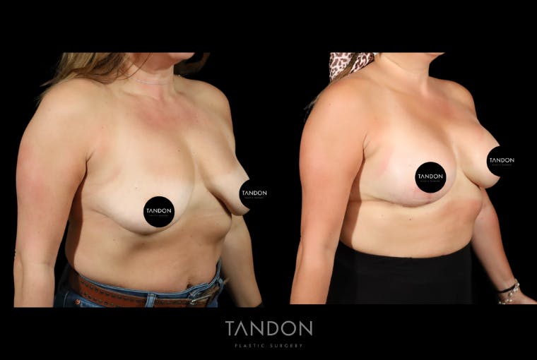 Breast Implant Exchange Before & After Gallery - Patient 305896 - Image 2