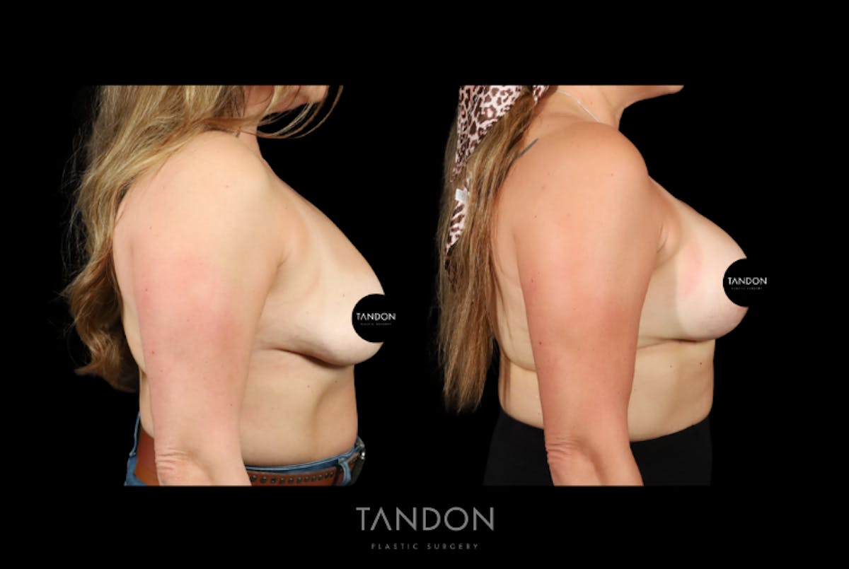 Breast Implant Exchange Before & After Gallery - Patient 305896 - Image 3