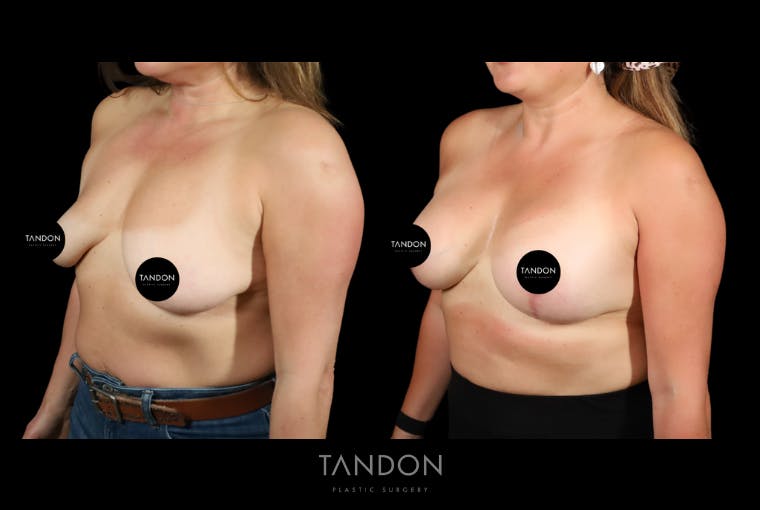 Breast Implant Exchange Before & After Gallery - Patient 305896 - Image 4