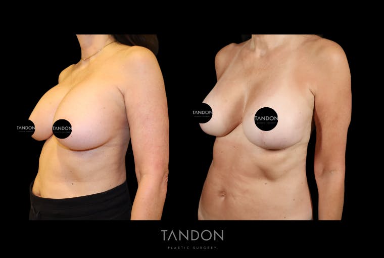 Breast Lift Before & After Gallery - Patient 807211 - Image 5