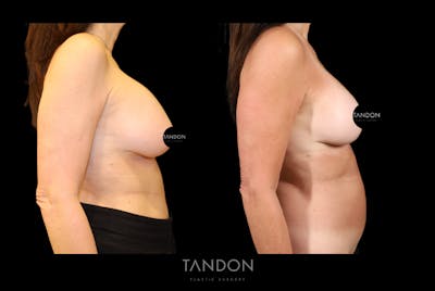 Breast Lift Before & After Gallery - Patient 807211 - Image 2