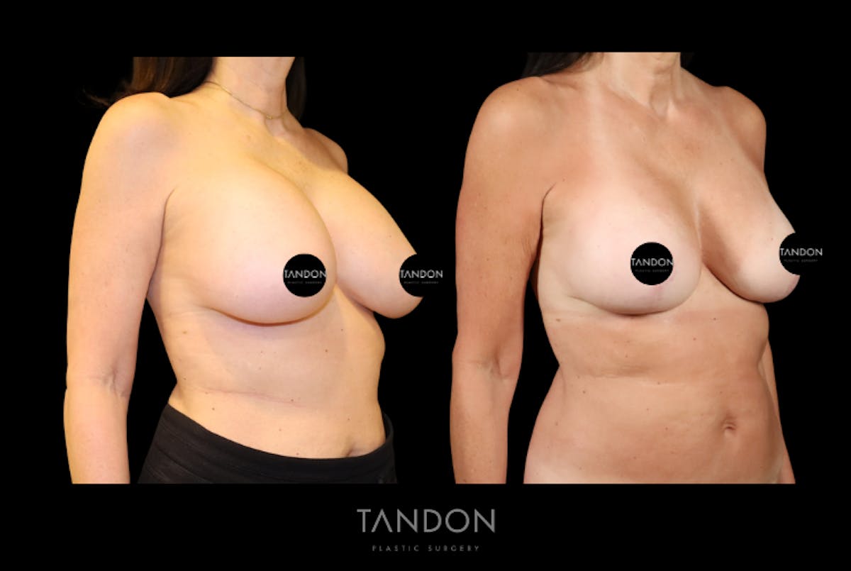 Breast Lift Before & After Gallery - Patient 807211 - Image 3