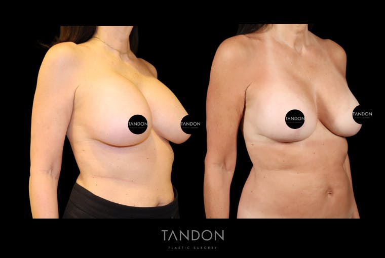 Breast Lift Before & After Gallery - Patient 807211 - Image 3