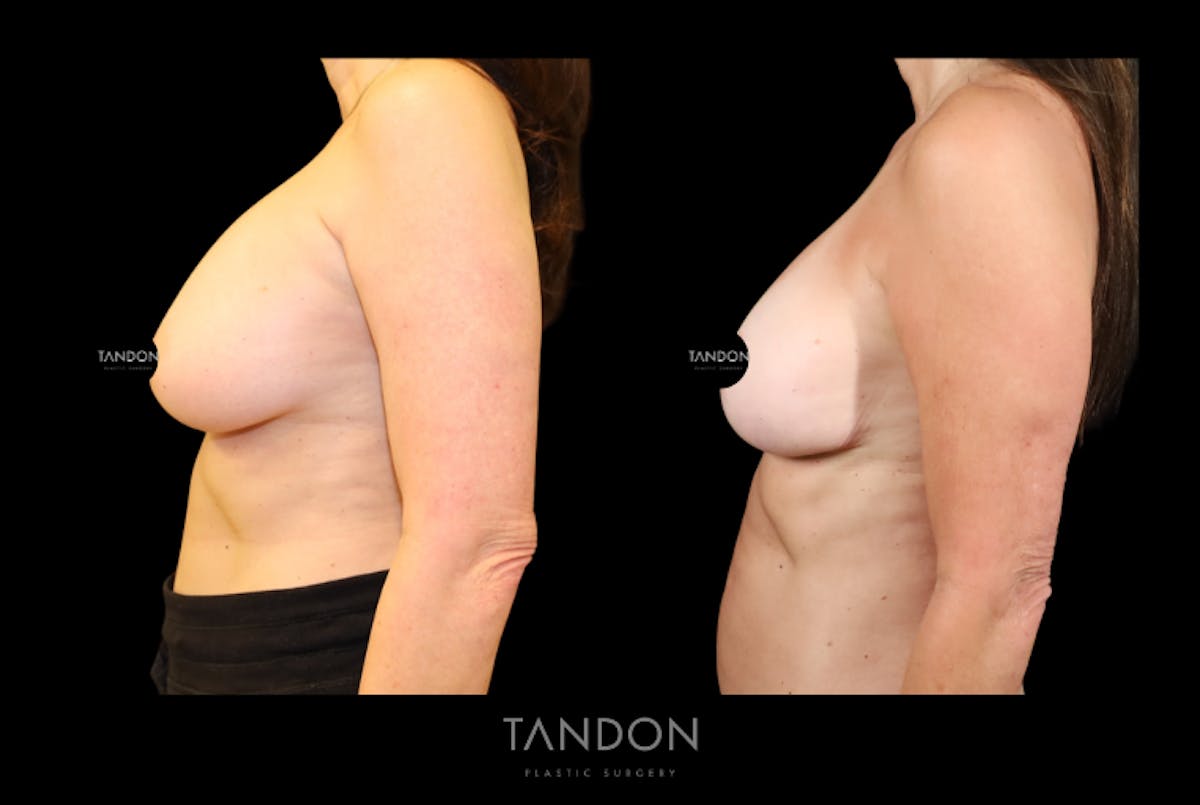 Breast Lift Before & After Gallery - Patient 807211 - Image 4