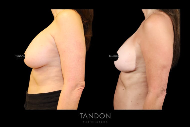 Breast Lift Before & After Gallery - Patient 807211 - Image 4