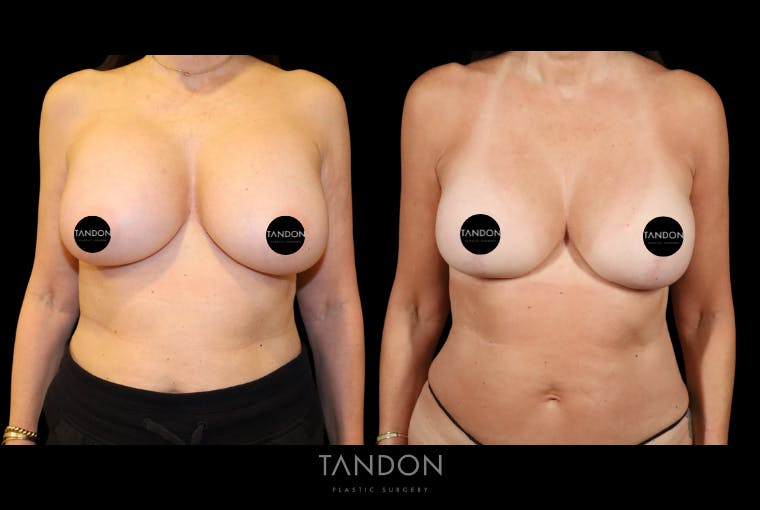 Breast Lift Before & After Gallery - Patient 807211 - Image 1