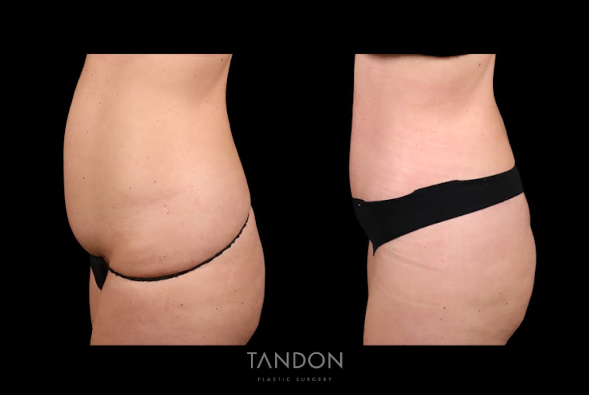 Abdominoplasty (Tummy Tuck) Before & After Gallery - Patient 428875 - Image 3