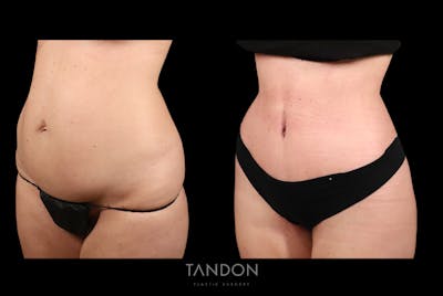 Abdominoplasty (Tummy Tuck) Before & After Gallery - Patient 428875 - Image 2