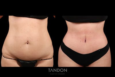 Liposuction and Fat Transfer Before & After Gallery - Patient 237807 - Image 1