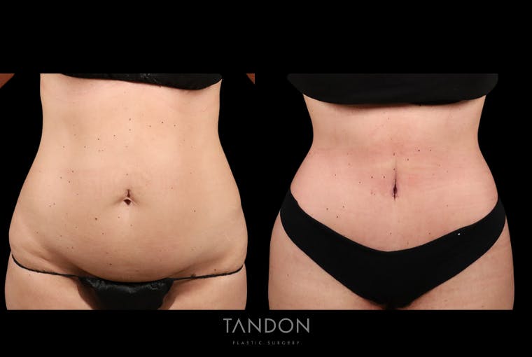 Abdominoplasty (Tummy Tuck) Before & After Gallery - Patient 428875 - Image 1