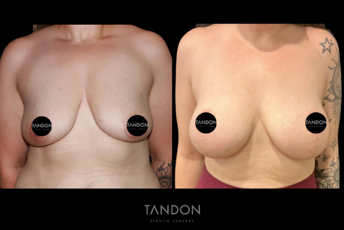 Breast Augmentation  Before & After Gallery - Patient 221952 - Image 1