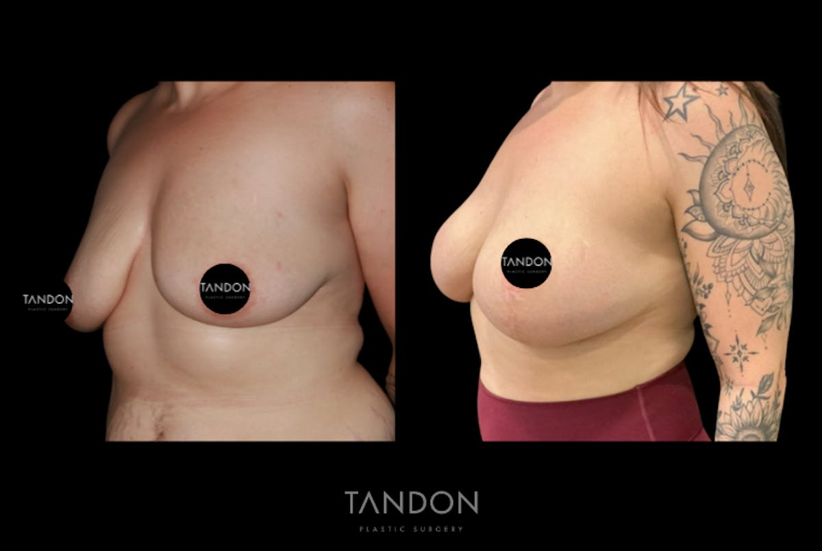 Breast Augmentation  Before & After Gallery - Patient 221952 - Image 2