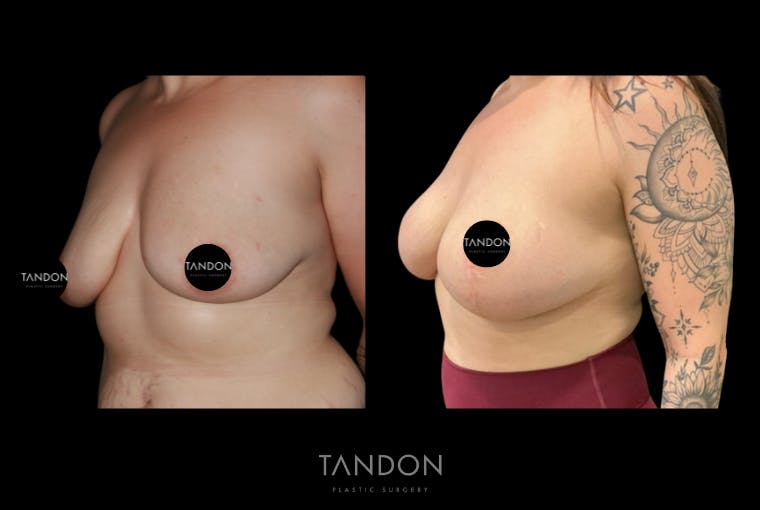 Breast Augmentation Before & After Gallery - Patient 221952 - Image 2