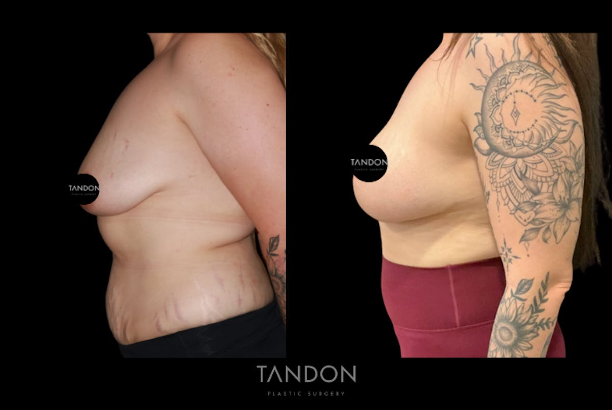 Breast Augmentation  Before & After Gallery - Patient 221952 - Image 3