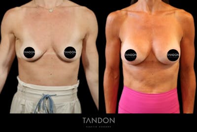 Breast Augmentation Before & After Gallery - Patient 160872 - Image 1