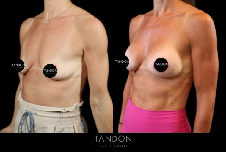 Preservé by Motiva Breast Augmentation Before & After Gallery - Patient 363939 - Image 2