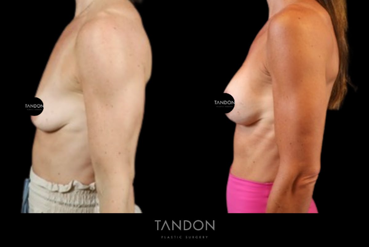 Preservé by Motiva Breast Augmentation Before & After Gallery - Patient 363939 - Image 3