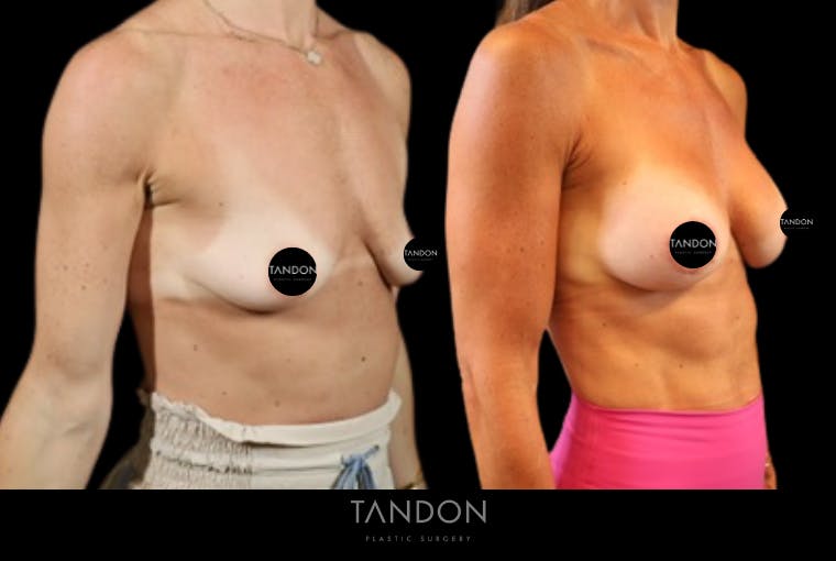 Preservé by Motiva Breast Augmentation Before & After Gallery - Patient 363939 - Image 4